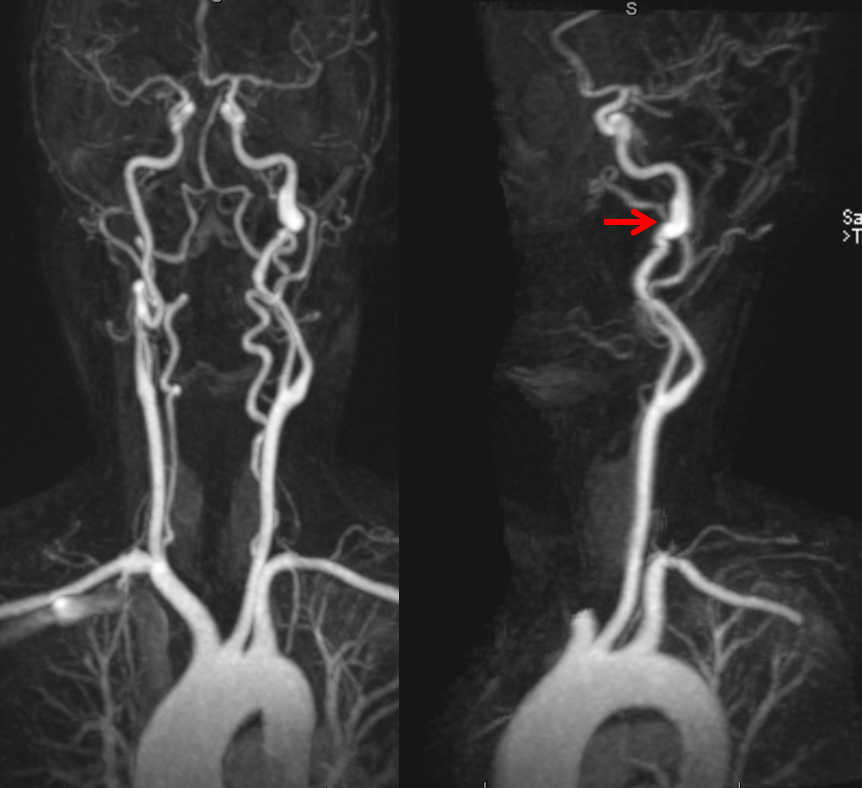 pulsatile-tinnitus-carotid-artery-dissection-neuroangio